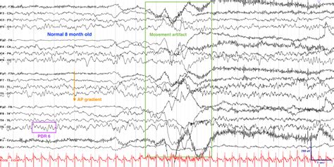 abnormal eeg results in child.
